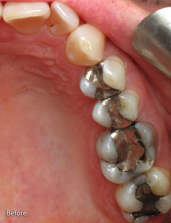 Before Restorative Dentistry from HighPointe Dental