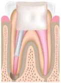 Animated image of a Root Canal