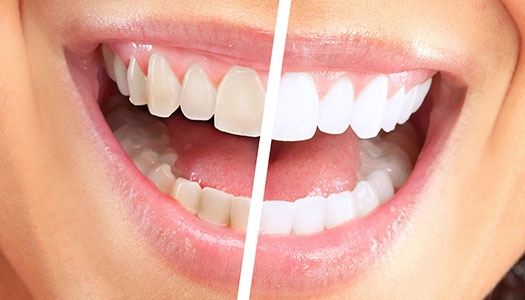 image of discolored teeth corrected