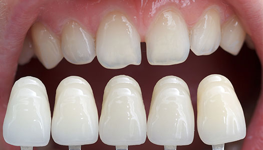 Image of porcelain veneers held next to jagged teeth